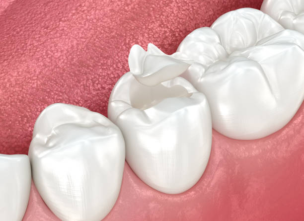 Best Wisdom Tooth Removal  in Choudrant, LA